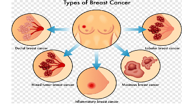  افضل دكتور سرطان الثدي في العراق | سرطان الثدي
