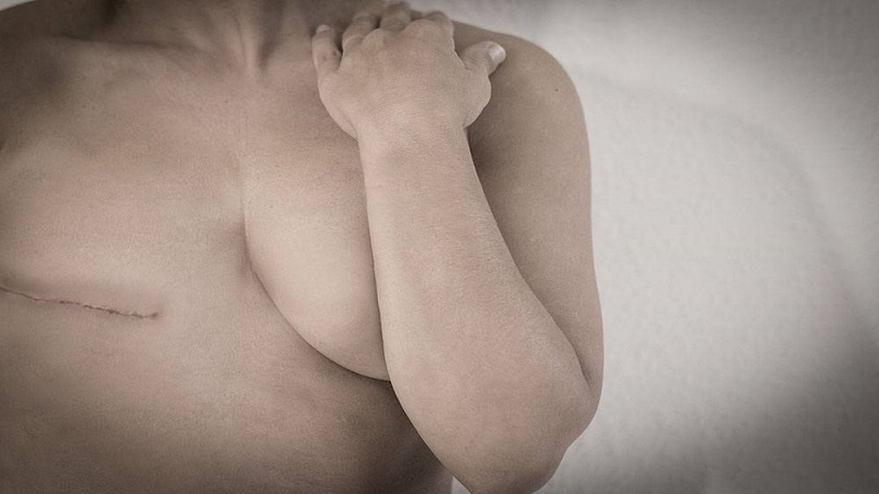 افضل جراح سرطان ثدي في العراق | سرطان الثدي، إلى أي مدى يؤثر العلاج على المظهر؟