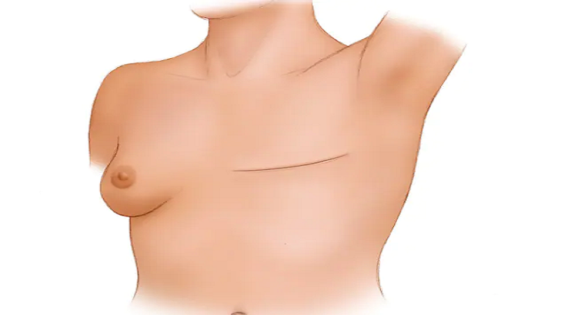 جراح پستان اصفهان  | الجراحة الترميمية لسرطان الثدي 1