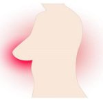 أورام الثدي