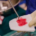 الخزعة بالشفط الثدي