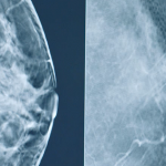 تشخيص الداء الكسِي الليفي في الثدي