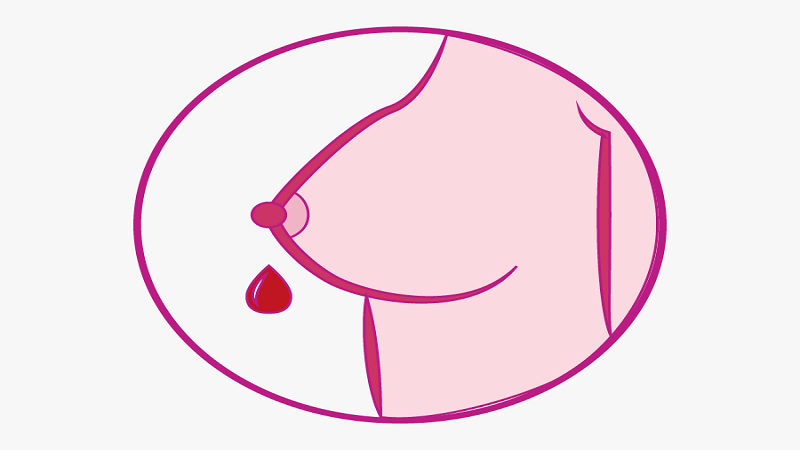  افضل دكتور سرطان الثدي في العراق |نَجيج حلمة الثَّدي